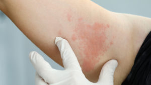 Management of shingles